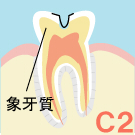象牙質のむし歯